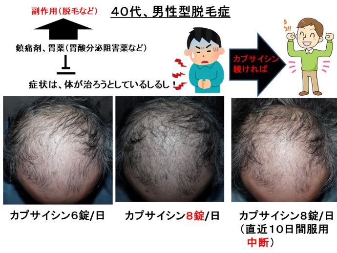 円形脱毛症　病院